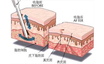 做抽脂減肥有什么危害