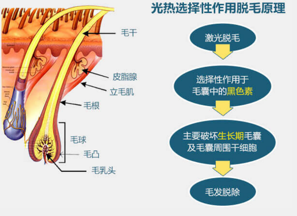 深圳激光脫毛對皮膚危害性大嗎