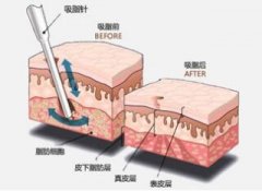 佛山美萊手臂吸脂有副作用嗎