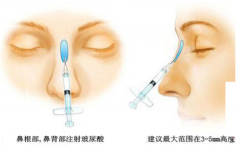 廣州哪家隆鼻比較好呢