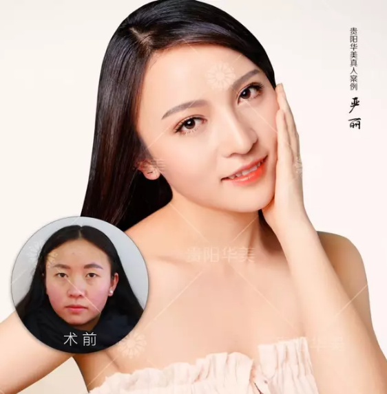 貴陽激光美白美容手術費用要多少錢呢