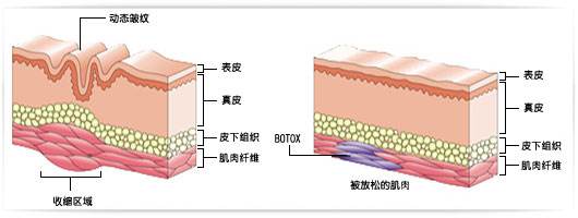 廣州注射除皺針會(huì)不會(huì)出現(xiàn)不良的反應(yīng)呢