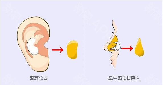 自體軟骨隆鼻