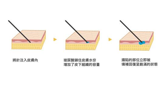 成都做玻尿酸除皺效果能維持多長時(shí)間