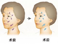 沈陽做射頻除皺安全不安全嗎