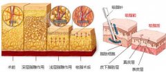 上海做吸脂減肥會對身體有危險(xiǎn)嗎