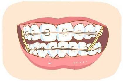 廣州牙齒矯正隱形的效果好不好呢
