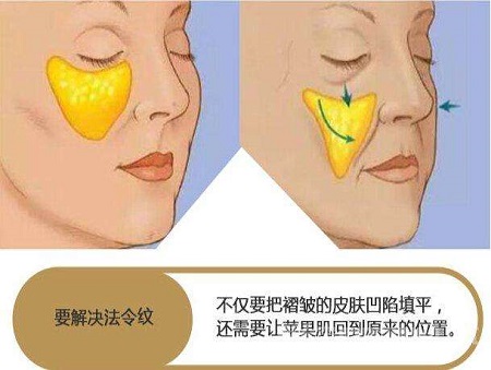 脂肪填充法令紋能維持多少時間？