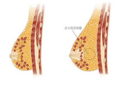 做自體脂肪豐胸手術(shù)會不會出現(xiàn)硬塊的現(xiàn)象