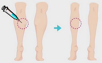一針瘦腿多少錢？