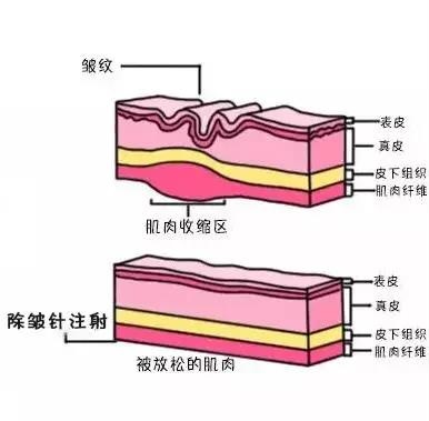 除皺針