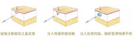 法令紋、川字紋