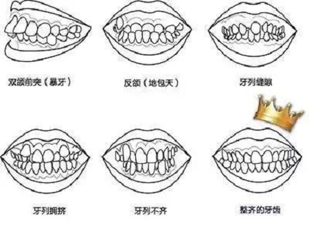 矯正牙齒