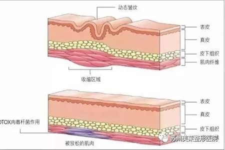 你無法用玻尿酸除掉所有皺紋！