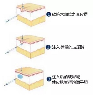 用玻尿酸治療鼻唇溝，一定要注意這種情況！