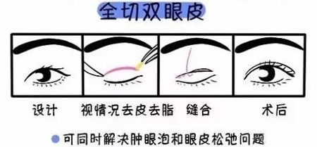 美眼張誠坐診美萊，淺談為什么你的眼睛不夠美？