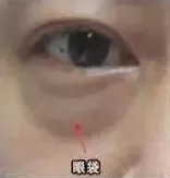 暫時性眼袋