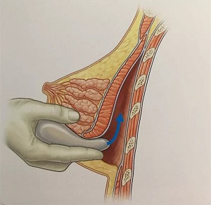假體隆胸的三種切口應(yīng)該怎樣選擇