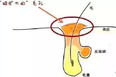 毛孔粗大應該要怎么辦