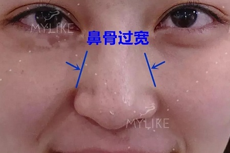 側(cè)面看鼻梁不矮,正面看鼻子卻很塌是什么原因？