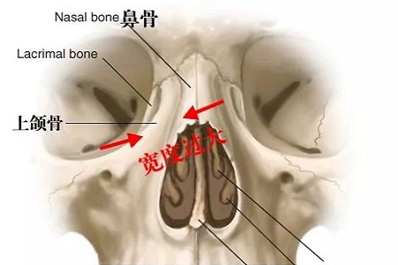 側面看鼻梁不矮,正面看鼻子卻很塌是什么原因？