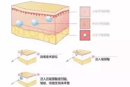 深究玻尿酸有哪些類型和作用