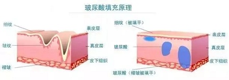 玻尿酸