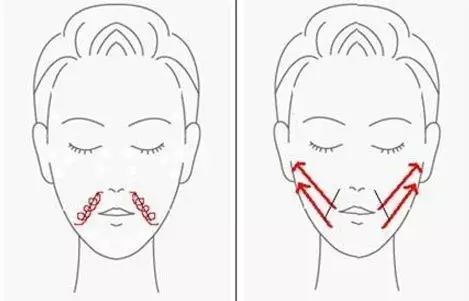 玻尿酸去法令紋