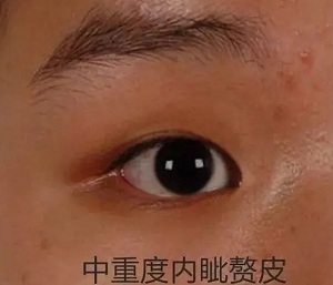 中度內眥贅皮