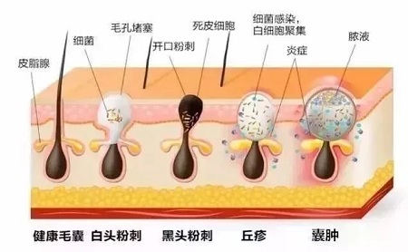 痤瘡的形成和演變