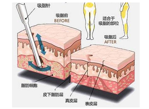 鄭州美萊吸脂瘦身等于減重？