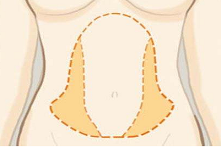 腰腹吸脂瘦身注意事項有哪些