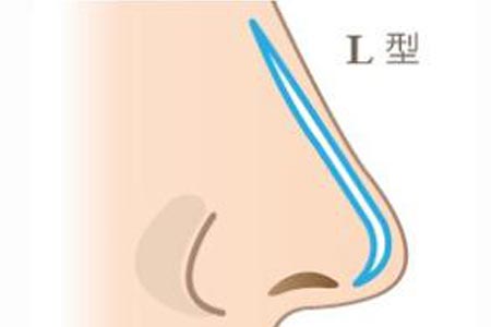 進口硅膠假體隆鼻手術多少錢