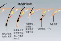 蘇州脫毛醫(yī)院做冰點脫毛的價格多少，對身體有沒有傷害