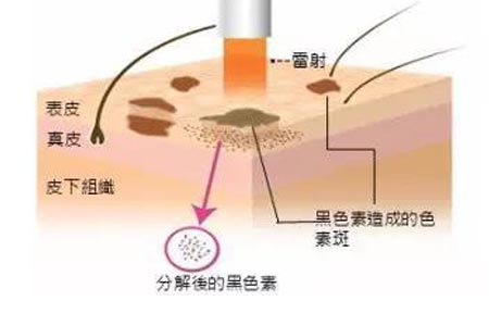 激光祛斑效果怎么樣